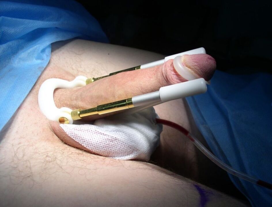 носіння екстендера після операції